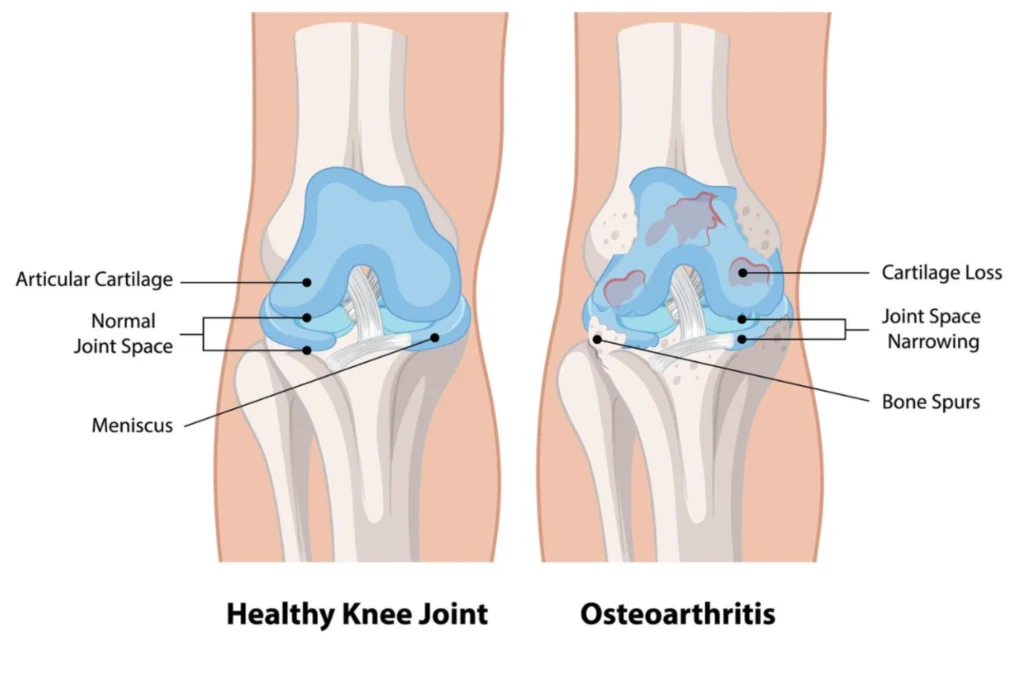 osteoarthritis