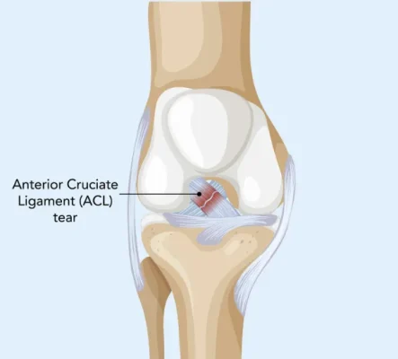 acl tear